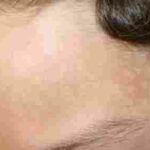 كريم لعلاج البقع البيضاء في الوجه عند الأطفال
