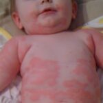 أعراض حساسية اللبن الصناعي عند الرضع