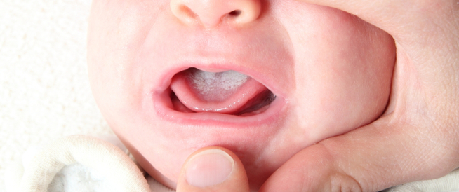 علاج فطريات الفم للأطفال