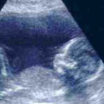 معرفة نوع الجنين في الشهر الثاني